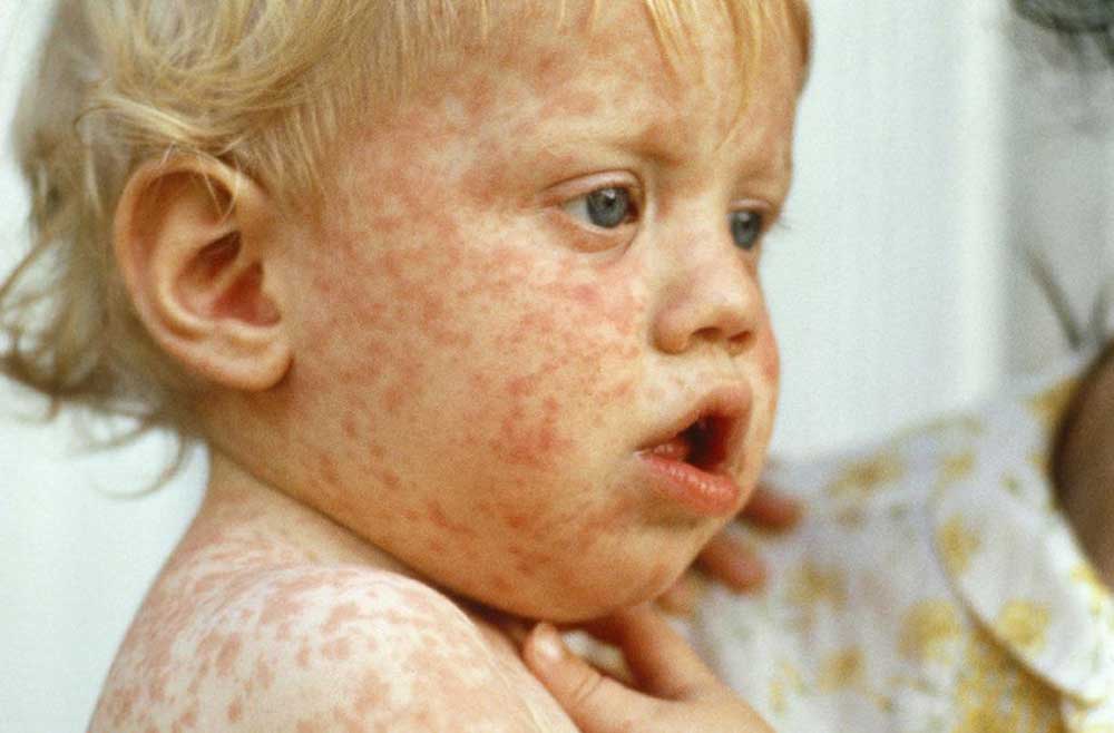 Boy with measles. Credit: FBR
