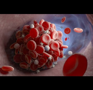 Depiction of a blood clot forming inside a blood vessel.