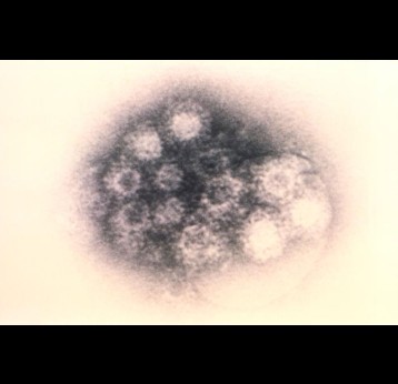 The cause of ‘tomato flu’: the coxsackievirus. CDC/ Dr. Erskine Palmer