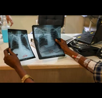 Chest x-rays are more sensitive for screening for TB. PUNIT PARANJPE/AFP via Getty Images