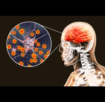  Japanese encephalitis, 3D illustration showing brain infection and close-up view of viruses in the brain.