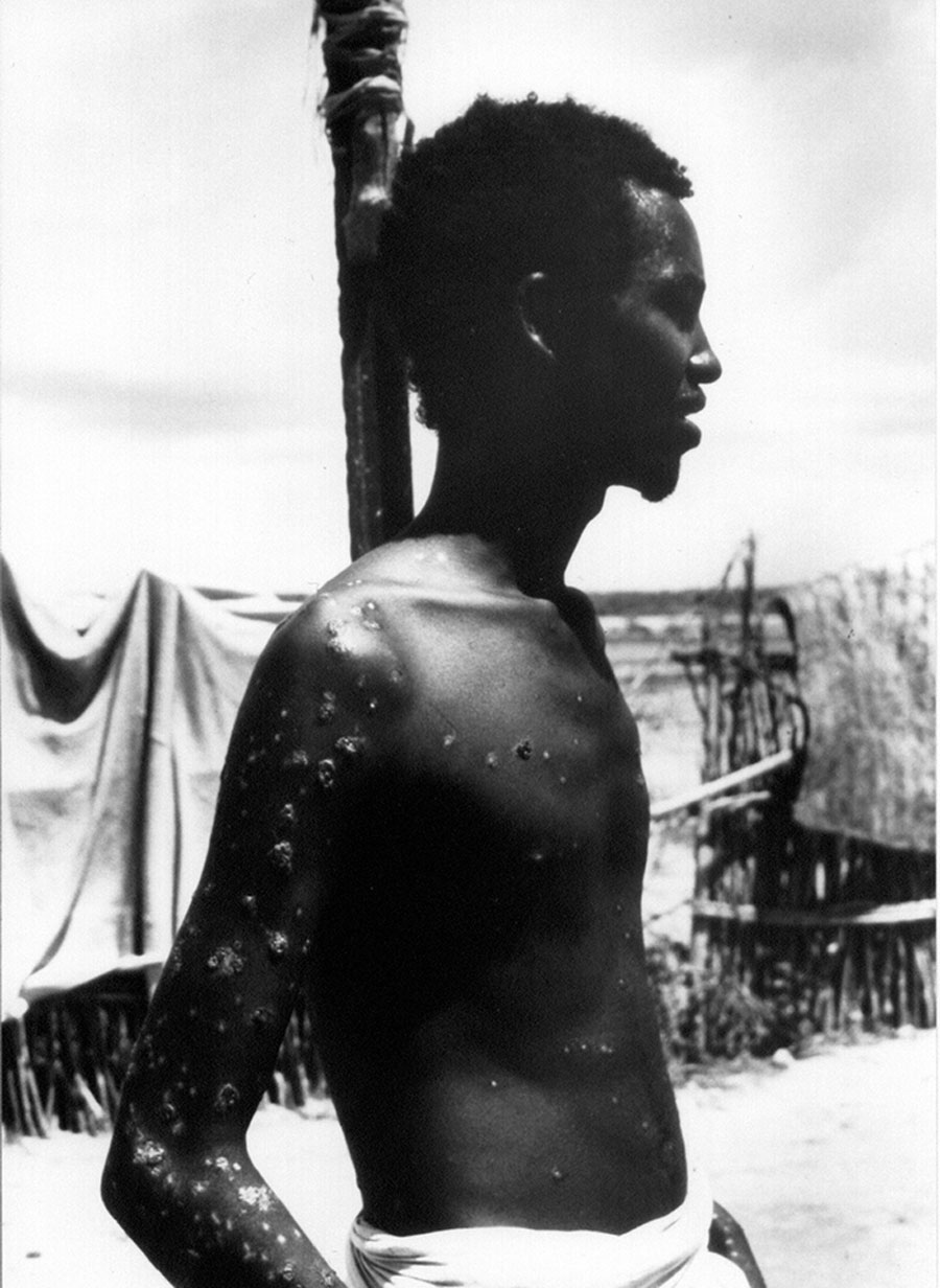 23-year-old Ali Maow Maalin of Merka town, Somalia, the last recorded case of the smallpox disease, in 1977. Credit: WHO /John F. Wickett