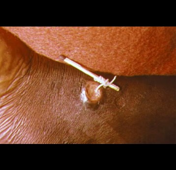 Guinea worms are long, white parasites that emerge from the legs of infected people through painful blisters. Credit: CDC/Wikimedia Commons
