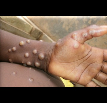 Mpox symptoms on a forearm and hand. Credit: Nigeria Centre for Disease Control