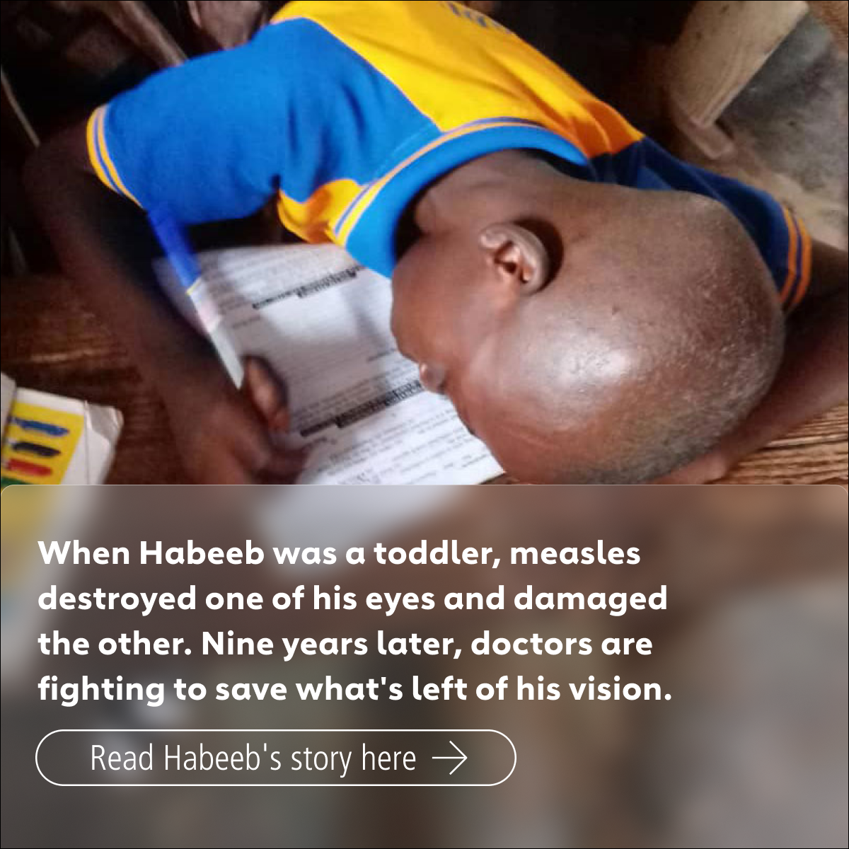Measles blindness: Habeeb’s story