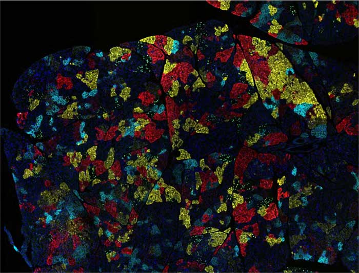 Most tumors are made of many different kinds of cancer cells, as shown in this pancreatic cancer sample from a mouse. Ravikanth Maddipati/Abramson Cancer Center at the University of Pennsylvania via National Cancer Institute