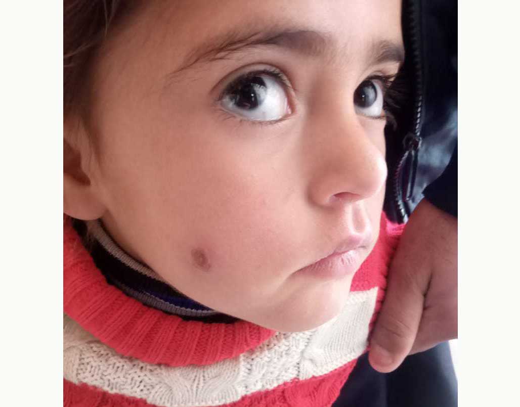 一名因皮肤利什米菌病感染而脸上有疤痕的儿童正在医院接受检查。