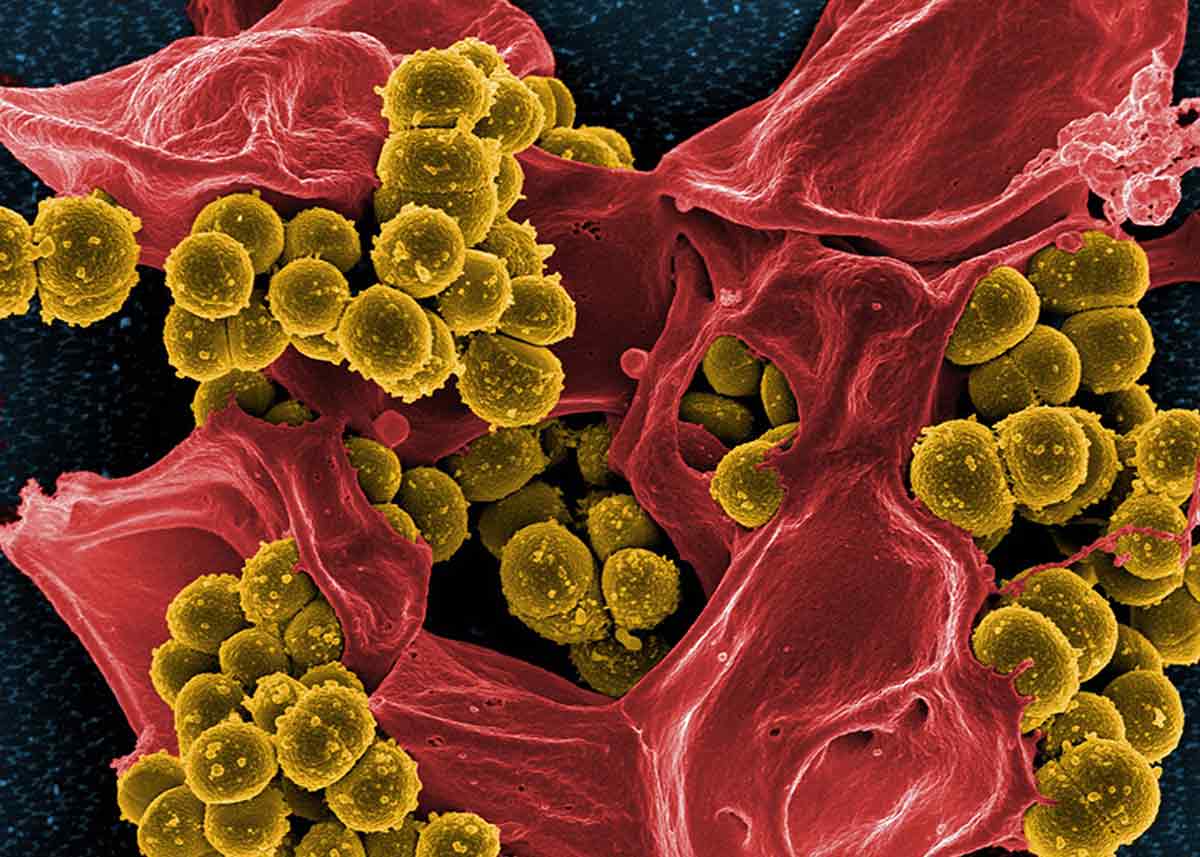 Antibiotic resistance is a growing problem. This photo shows methicillin-resistant Staphylococcus aureus (yellow) — one of the most serious resistant pathogens — and a dead human white blood cell (red). Researchers have had some success in reversing antibiotic resistance by treating infected patients with particular bacteriophages.  CREDIT: NATIONAL INSTITUTE OF ALLERGY AND INFECTIOUS DISEASES (NIAID) / NIH